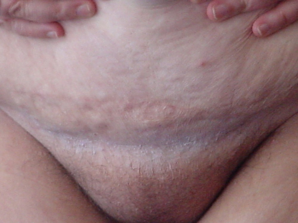 Голые женщины после кесарево