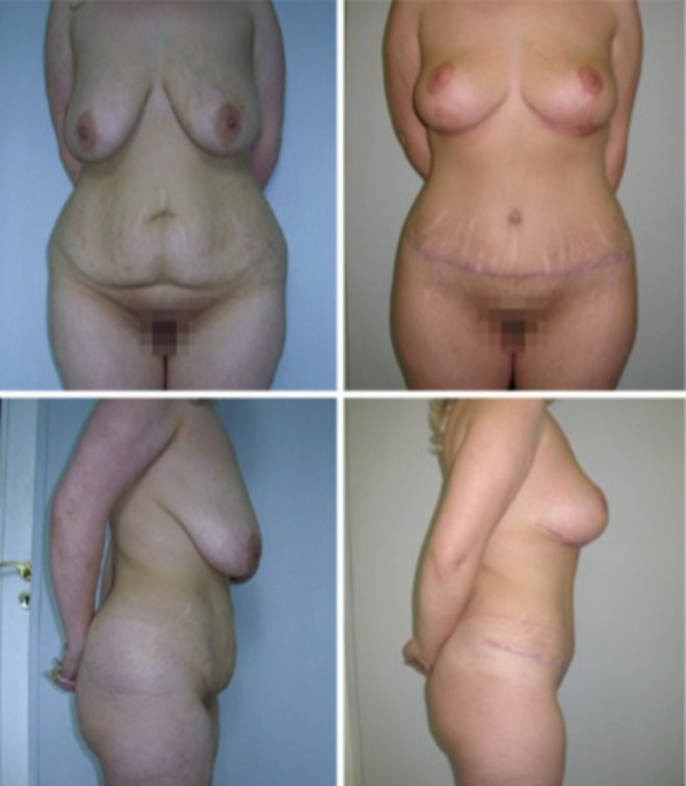 Голые сиськи после похудения